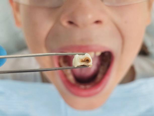 Best Urgent Care for Lost Fillings or Crowns in High Point, NC